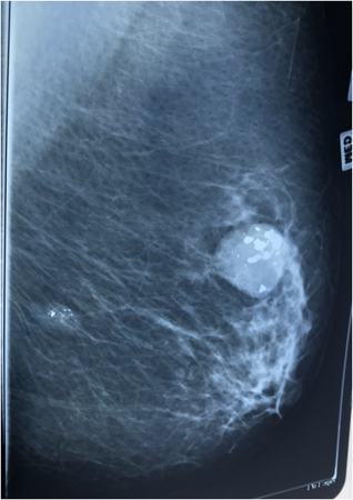 Маммография - снимок 5