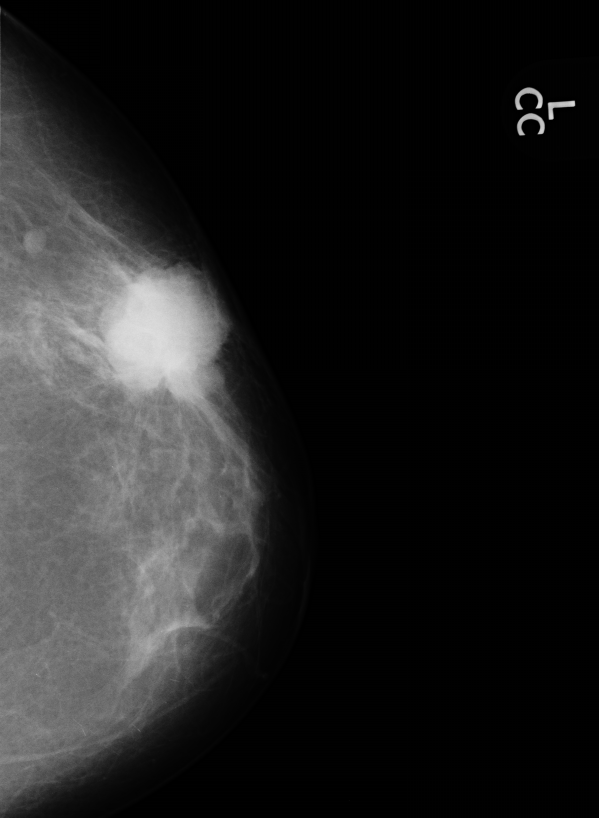 Как выглядит рак на маммографии 1.